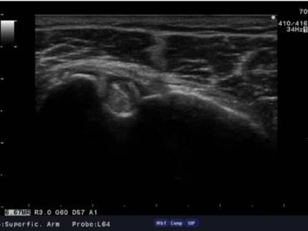 肩関節のエコー画像